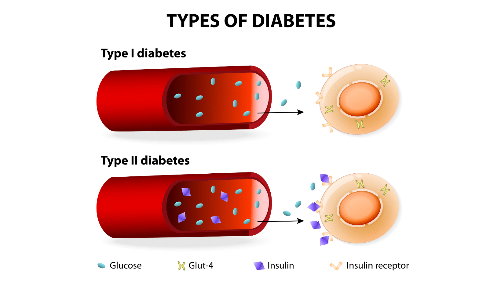 Types of diabetes
